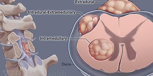 Glioma Surgery